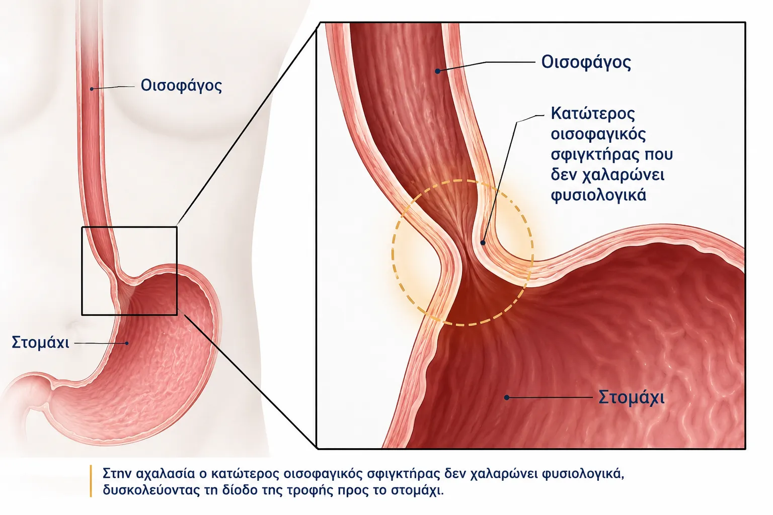 Αχαλασία Οισοφάγου περιγραφη